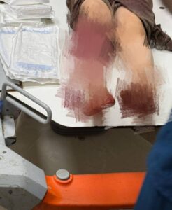 MEITU_٢٠٢٦٠٢٢٠_٢٢٤٧٤٦٦٧٥-246x300 مصدر طبي: حالة الطفل المصاب بطلق خرطوش في القليوبية خطيرة وقد تستدعي البتر